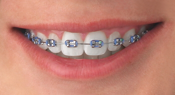 Traditional Metal braces Johor Bahru (JB) | Dental Clinic Johor Bahru (JB) | Children Friendly Dentist Johor Bahru (JB) | Invisalign Johor Bahru (JB)